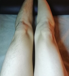 ごっそり取れる 脚 スネ 腿 の脱毛 ビフォーアフター写真 Nadio